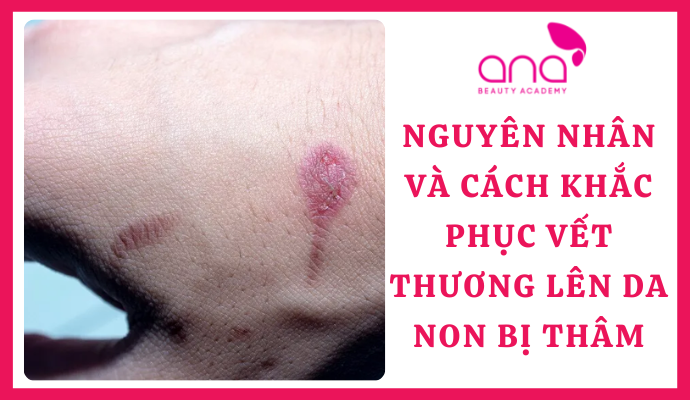 Nguyên Nhân Và Cách Khắc Phục Vết Thương Lên Da Non Bị Thâm