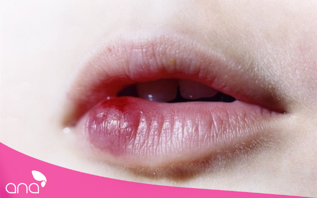 Dấu hiệu xăm môi bị nhiễm trùng và cách khắc phục  Top10tphcm