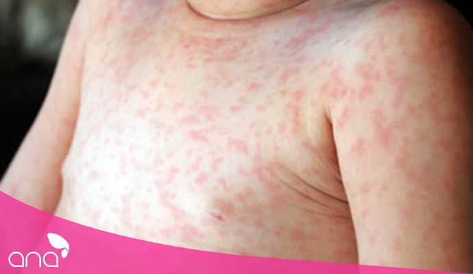 Da nổi chấm đỏ như nốt ruồi son không ngứa có nguy hiểm không