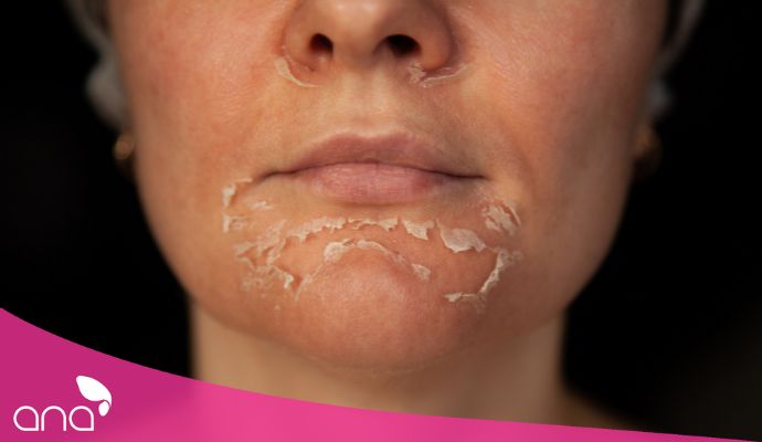 Hiện tượng sau khi peel da gì?