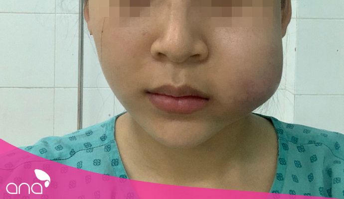 Tiêm filler sau 1 năm bị sưng: Nguyên nhân và giải pháp hiệu quả