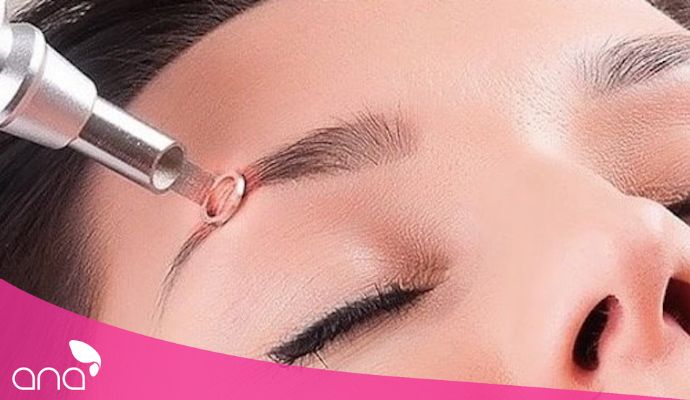 hút mực chân mày bằng laser