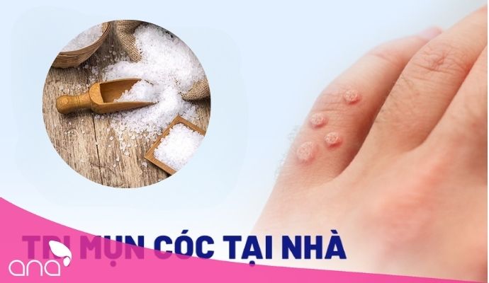 trị mụn cóc bằng nước muối hiệu quả