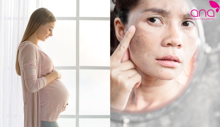 Biến động hormone làm nám dễ hình thành