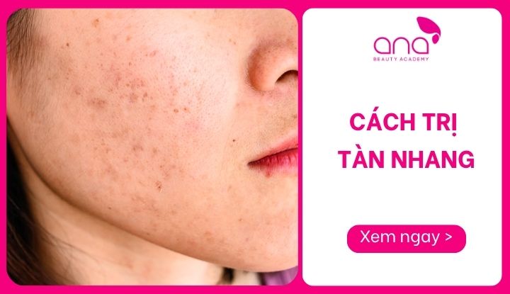Cách Trị Tàn Nhang