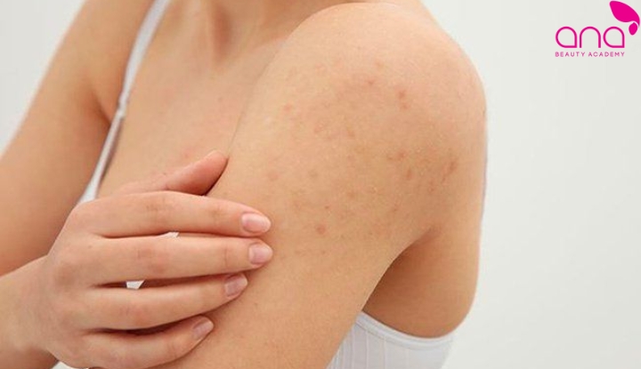 Chăm sóc dày sừng nang lông