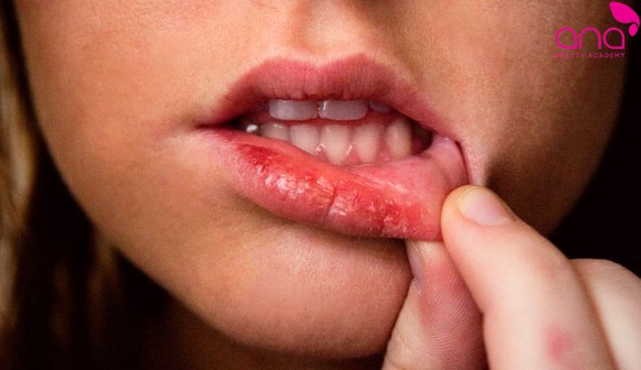 Chăm sóc sai cách khiến môi dễ kích ứng và xuất hiện mụn trắng (Nguồn: Internet)