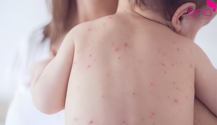 Chấm xuất huyết sốt xuất huyết