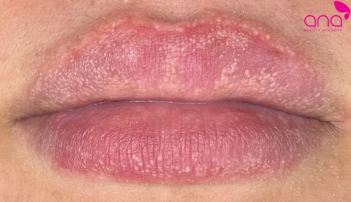 Cơ địa nhạy cảm ảnh hưởng đến phản ứng và tốc độ phục hồi (Nguồn: Internet)