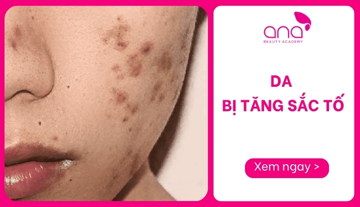 da bị tăng sắc tố