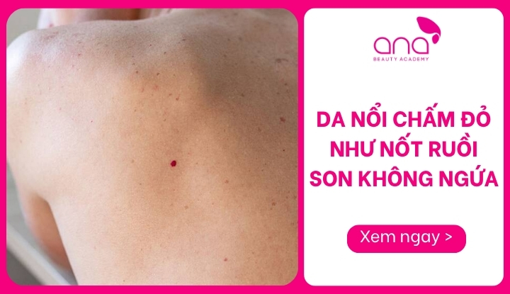 da nổi chấm đỏ như nốt ruồi son không ngứa