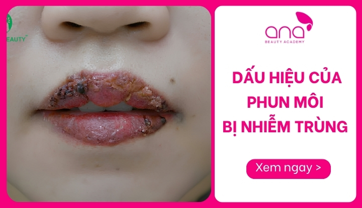 dấu hiệu của phun môi bị nhiễm trùng