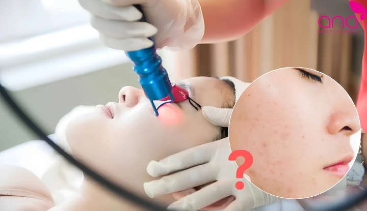 Đốt tàn nhang xong có để lại thâm hay không?