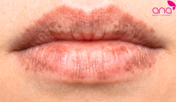 Màu môi lên không đều hoặc loang lổ