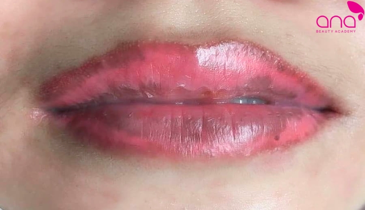 Môi bị tụ máu, bầm tím