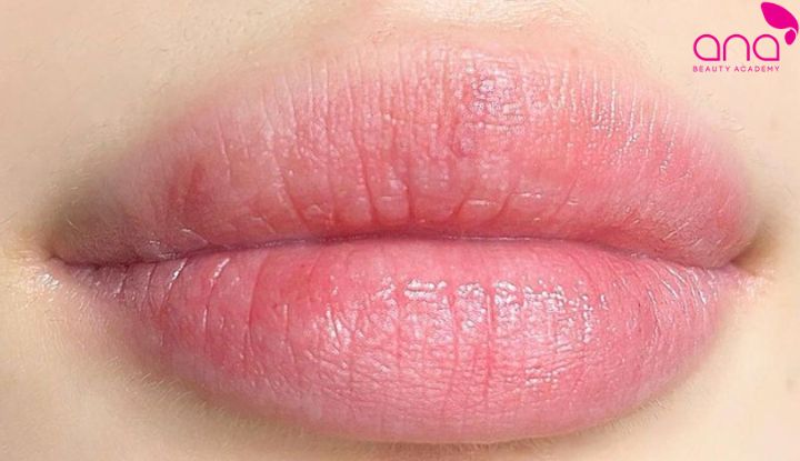 Nhạt lòng sau 1 tuần thường cần tiếp tục dưỡng và theo dõi (Nguồn: Internet)