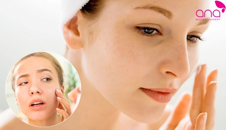 Nguyên nhân khiến da dễ bị thâm sau khi đốt tàn nhang
