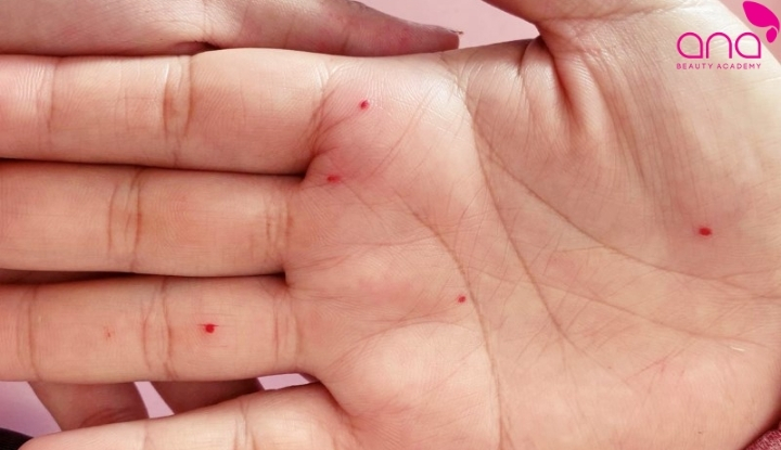 Nốt ruồi son lành tính