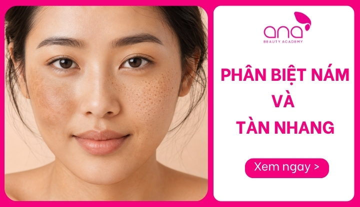 Cách phân biệt nám và tàn nhang chính xác