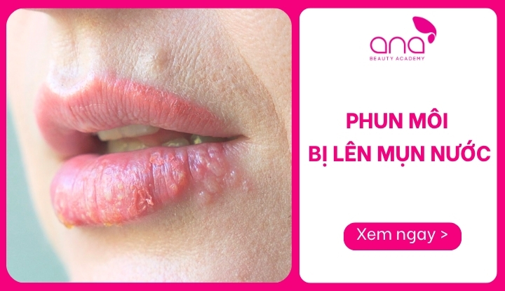 phun môi bị lên mụn nước