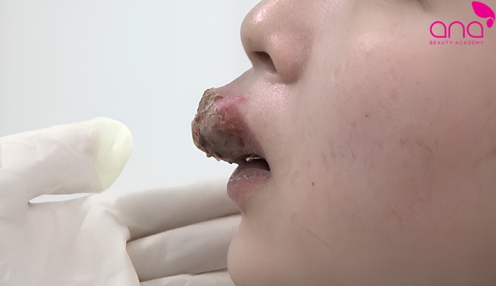 Trường hợp môi nhiễm trùng nặng