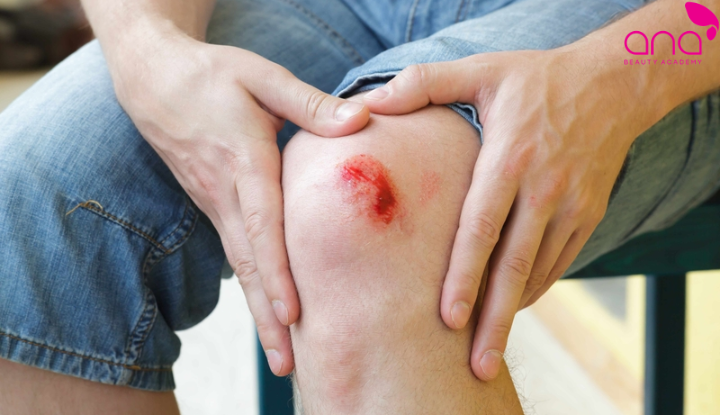 Thời gian lành phụ thuộc độ sâu tổn thương, cơ địa và cách chăm sóc