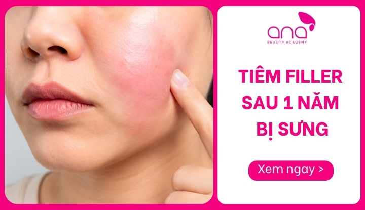 tiêm filler sau 1 năm bị sưng
