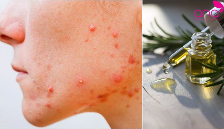 Tinh dầu tràm trà hỗ trợ giảm mụn sưng viêm 