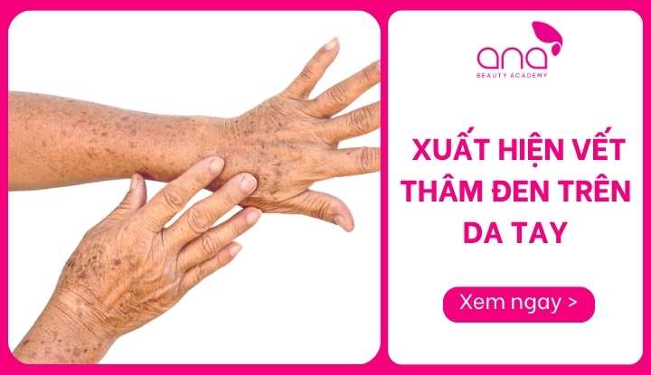 xuất hiện vết thâm đen trên da tay