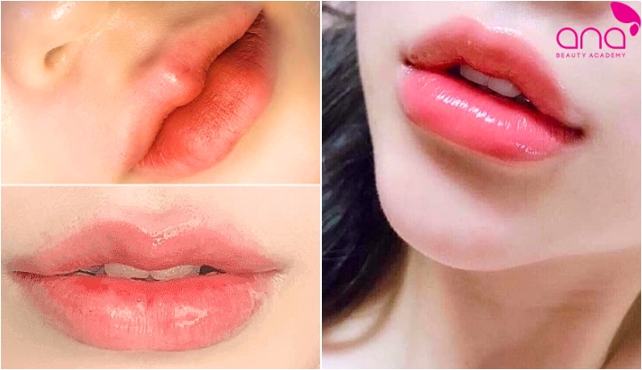 Dáng môi tiêm filler đẹp kiểu baby ngọt ngào
