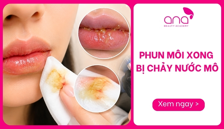 phun môi xong bị chảy nước mô