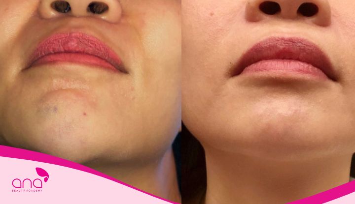 Tiêm filler khi nào cần đến bác sĩ