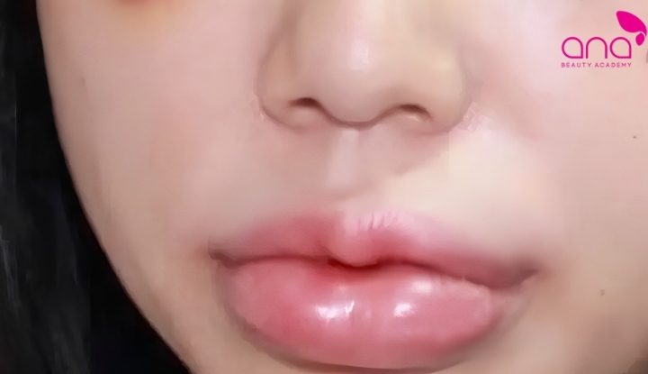 Vùng tiêm có thể hơi cứng, sưng nhẹ và căng tức trong những ngày đầu