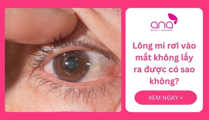 Lông mi rơi vào mắt không lấy ra có sao không