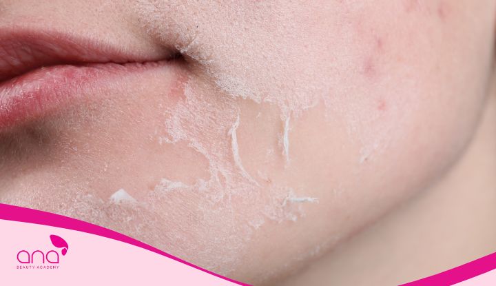 Biểu hiện quá trình bong da sau phi kim