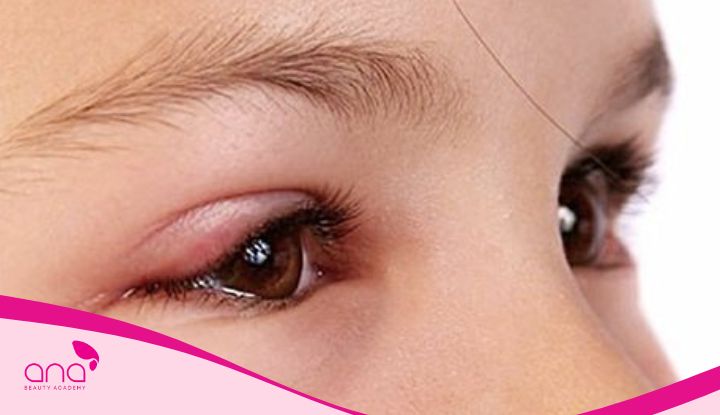 Miếng dán kích mí có hại không