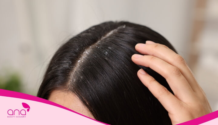 Bồ kết còn có tác dụng trị gàu hiệu quả