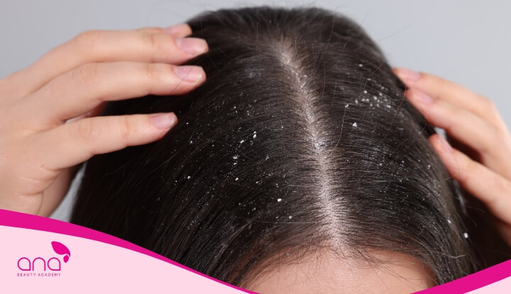 Vỏ cam trị gàu hiệu quả nhờ các hợp chất như limonene và pectin giúp tẩy tế bào chết nhẹ nhàng 