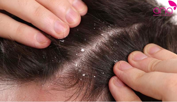 Gàu còn sót lại sau khi gội