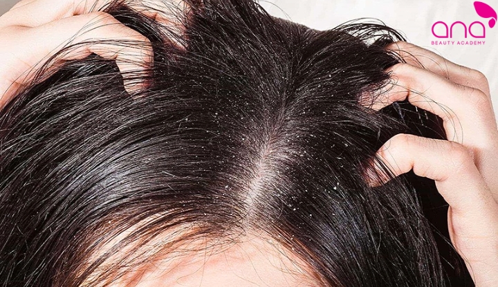 Da đầu bị nấm