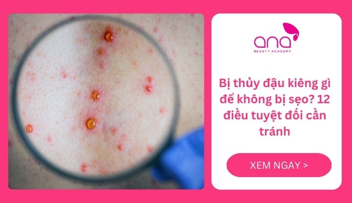 Bị thủy đậu kiêng gì để không bị sẹo