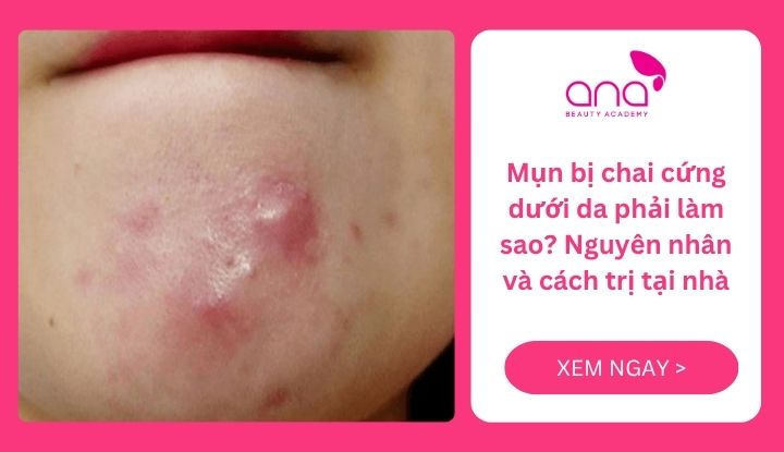 mụn bị chai cứng dưới da phải làm sao