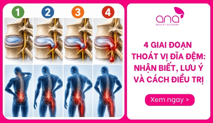 4 giai đoạn thoát vị đĩa đệm