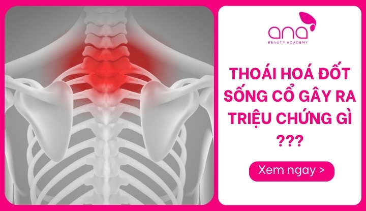 thoái hoá đốt sống cổ gây ra triệu chứng gì