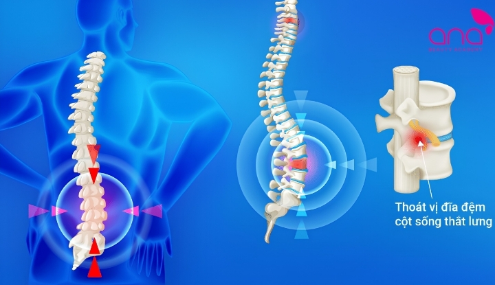 Thoát vị đĩa đệm là gì