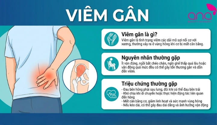 Viêm gân