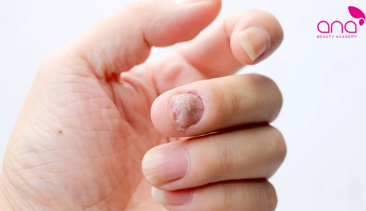 Dụng cụ làm móng dùng chung có thể làm lây nấm móng tay