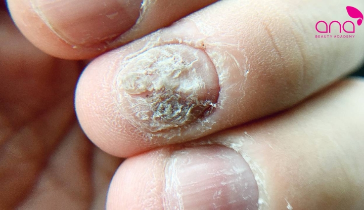 Nấm sợi Dermatophytes và Trichophyton xâm nhập vào móng tay