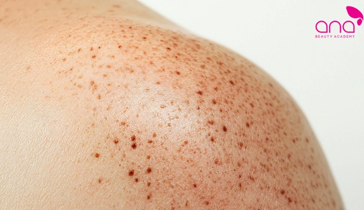 Dát sắc tố phẳng do ánh nắng tích lũy 