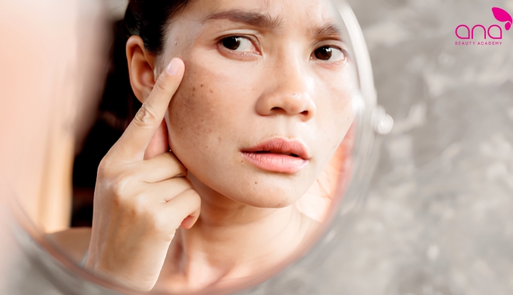 Tia UV thúc đẩy da tăng sắc tố 